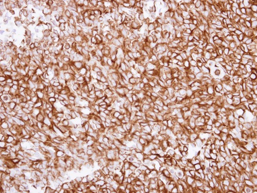 IHC of paraffin-embedded Breast ca using alpha Tubulin 1A antibody at 1:250 dilution.
