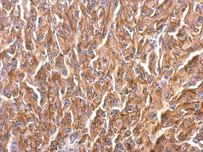 beta Tubulin 8 antibody [C2C3], C-term detects RP11-631M21.2 protein at cytosol on Mahlarvu xenograft by immunohistochemical analysis. Sample: Paraffin-embedded Mahlarvu xenograft. beta Tubulin 8 antibody [C2C3], C-term dilution:1:500.