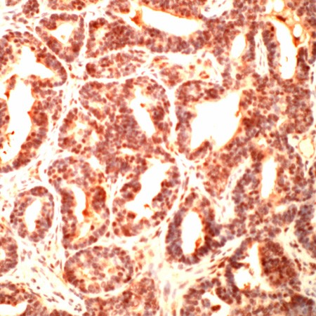 Human colon carcinoma stained with Anti-Tubulin gamma