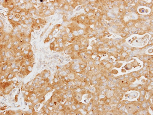 IHC of paraffin-embedded Colon ca using Tuftelin 1 antibody at 1:250 dilution.