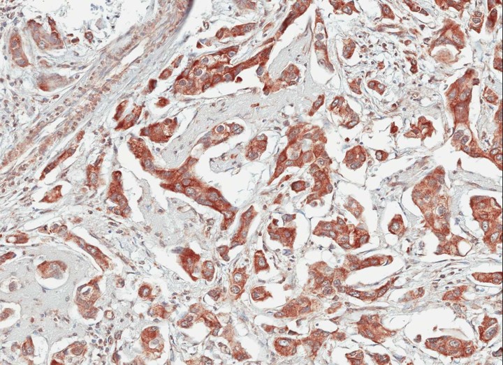 IHC of paraffin-embedded Breast CA using TULP1 antibody at 1:100 dilution.