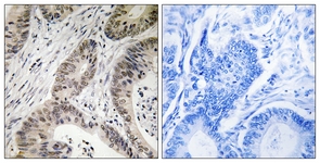 IHC of paraffin-embedded human colon carcinoma, using TUT1 Antibody. The picture on the right is treated with the synthesized peptide.
