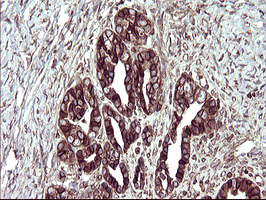 IHC of paraffin-embedded Adenocarcinoma of Human ovary tissue using anti-TMX1 mouse monoclonal antibody. (Heat-induced epitope retrieval by 10mM citric buffer, pH6.0, 120°C for 3min).