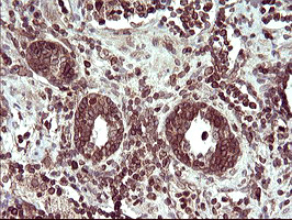 IHC of paraffin-embedded Carcinoma of Human prostate tissue using anti-TMX1 mouse monoclonal antibody. (Heat-induced epitope retrieval by 10mM citric buffer, pH6.0, 120°C for 3min).