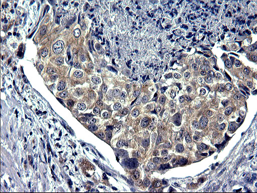 IHC of paraffin-embedded Carcinoma of Human prostate tissue using anti-TXNDC5 mouse monoclonal antibody. (Heat-induced epitope retrieval by 1 mM EDTA in 10mM Tris, pH8.5, 120°C for 3min).