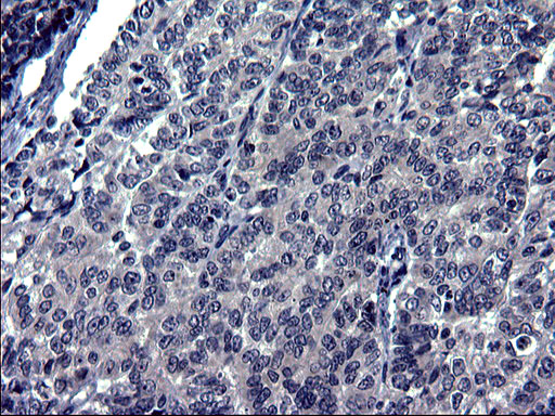 IHC of paraffin-embedded Adenocarcinoma of Human endometrium tissue using anti-TXNDC5 mouse monoclonal antibody. (Heat-induced epitope retrieval by 1 mM EDTA in 10mM Tris, pH8.5, 120°C for 3min).