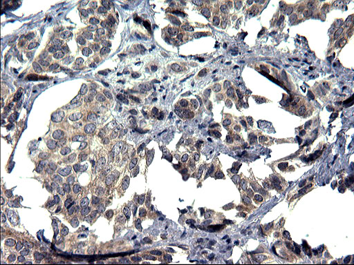 IHC of paraffin-embedded Adenocarcinoma of Human breast tissue using anti-TXNDC5 mouse monoclonal antibody. (Heat-induced epitope retrieval by 1 mM EDTA in 10mM Tris, pH8.5, 120°C for 3min).