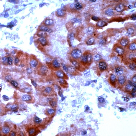 Liver carcinoma stained with Anti-TrxR2 antibody