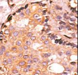 Formalin-fixed and paraffin-embedded human cancer tissue reacted with the primary antibody, which was peroxidase-conjugated to the secondary antibody, followed by AEC staining. This data demonstrates the use of this antibody for immunohistochemistry; clinical relevance has not been evaluated. BC = breast carcinoma; HC = hepatocarcinoma.