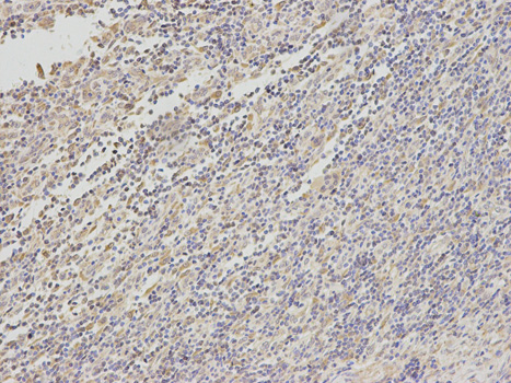 Immunohistochemistry of paraffin-embedded human stomach cancer using TYR antibody at dilution of 1:100 (200x lens).