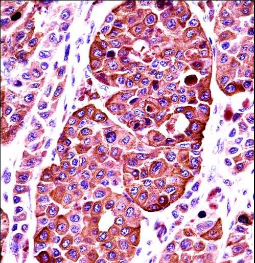 TYR Antibody immunohistochemistry of formalin-fixed and paraffin-embedded human melanoma followed by peroxidase-conjugated secondary antibody and DAB staining.