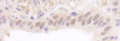 Detection of Human Rad6 by Immunohistochemistry. Sample: FFPE section of human stomach carcinoma. Antibody: Affinity purified rabbit anti-Rad6 used at a dilution of 1:1000 (1 ug/ml). Detection: DAB.