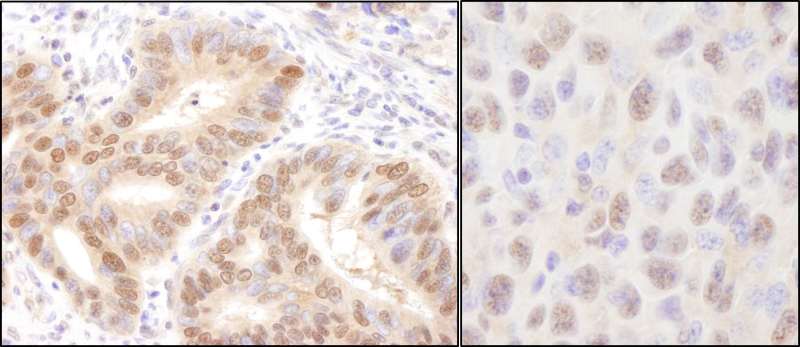Detection of Human and Mouse Rad6 by Immunohistochemistry. Sample: FFPE section of human stomach carcinoma (left) and mouse squamous cell carcinoma (right). Antibody: Affinity purified rabbit anti-Rad6 used at a dilution of 1:1000 (1 ug/ml). Detection: DAB.