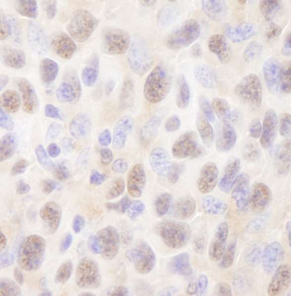 Detection of Mouse Rad6 by Immunohistochemistry. Sample: FFPE section of mouse squamous cell carcinoma. Antibody: Affinity purified rabbit anti-Rad6 used at a dilution of 1:250. Detection: DAB staining using anti-Rabbit IHC antibody at a dilution of 1:100.