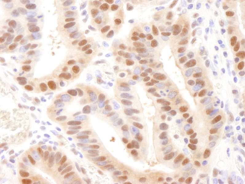 Detection of human Rad6 by Immunohistochemistry. Sample: FFPE section of human stomach adenocarcinoma. Antibody: Affinity purified rabbit anti-Rad6 used at a dilution of 1:250. Detection: DAB staining using anti-Rabbit IHC antibody at a dilution of 1:100.