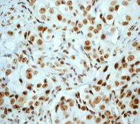 IHC of paraffin-embedded human breast carcinoma using anti-UBF1 antibody (LS-C105366).