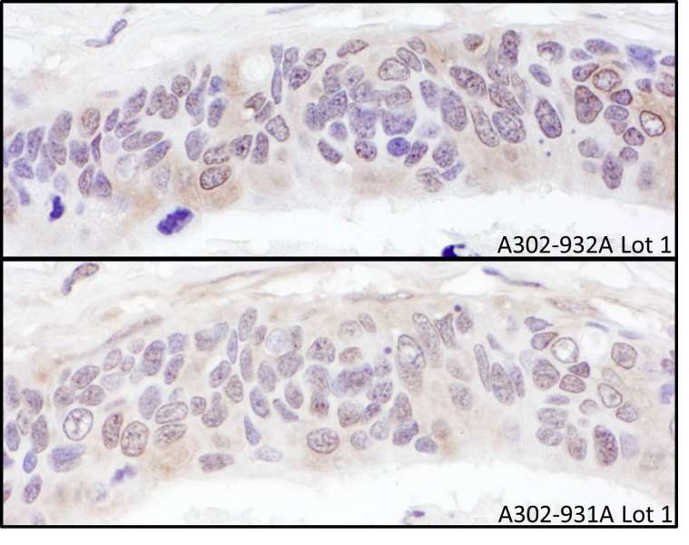 Detection of Human UBXD1 by Immunohistochemistry. Samples: FFPE serial sections of human ovarian carcinoma. Antibody: Affinity purified rabbit anti-UBXD1 used at a dilution of 1:1000 (1 ug/ml). Detection: DAB.