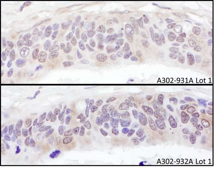 Detection of Human UBXD1 by Immunohistochemistry. Samples: FFPE serial sections of human ovarian carcinoma. Antibody: Affinity purified rabbit anti-UBXD1 used at a dilution of 1:1000 (1 ug/ml). Detection: DAB.