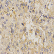 Immunohistochemistry of paraffin-embedded human liver cancer using UCP3 antibody at dilution of 1:200 (x400 lens).