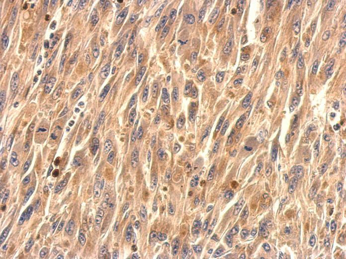 TMEM59 antibody detects TMEM59 protein at cytosol on U87 xenograft by immunohistochemical analysis. Sample: Paraffin-embedded U87 xenograft. TMEM59 antibody dilution:1:500.
