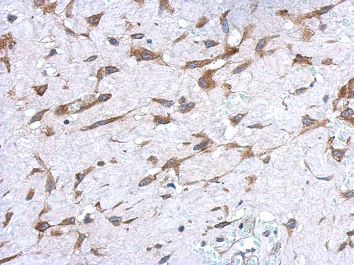IHC of paraffin-embedded Hepatoma using UGT1A9 antibody at 1:500 dilution.