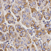 Immunohistochemistry of paraffin-embedded human liver cancer using UGT1A9 antibody at dilution of 1:200 (x400 lens).