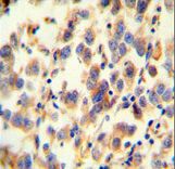 UGT3A2 antibody immunohistochemistry of formalin-fixed and paraffin-embedded human testis carcinoma followed by peroxidase-conjugated secondary antibody and DAB staining.