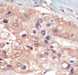 Formalin-fixed and paraffin-embedded human cancer tissue reacted with the primary antibody, which was peroxidase-conjugated to the secondary antibody, followed by DAB staining. This data demonstrates the use of this antibody for immunohistochemistry; clinical relevance has not been evaluated. BC = breast carcinoma; HC = hepatocarcinoma.