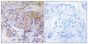 IHC of paraffin-embedded human breast carcinoma tissue, using ULK3 Antibody. The sample on the right was incubated with synthetic peptide.