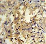 UPP2 antibody immunohistochemistry of formalin-fixed and paraffin-embedded human kidney carcinoma followed by peroxidase-conjugated secondary antibody and DAB staining.