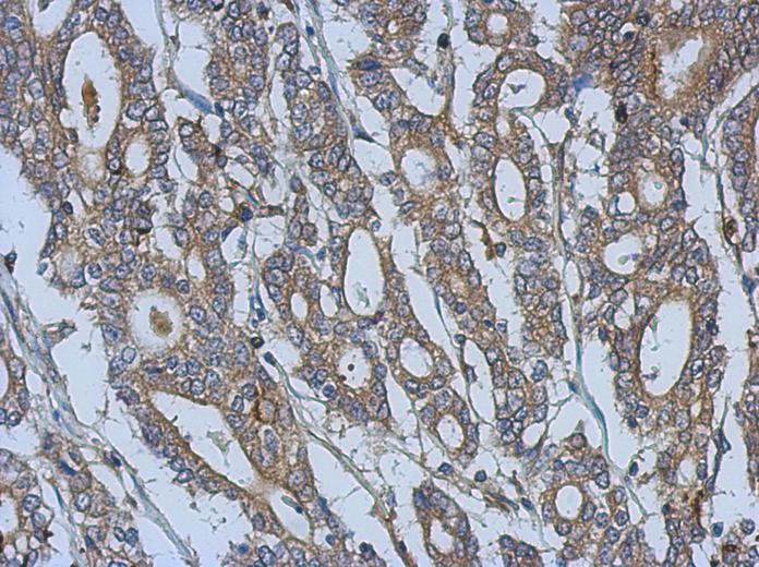 IHC of paraffin-embedded Gastric ca, using URP2 antibody at 1:500 dilution.