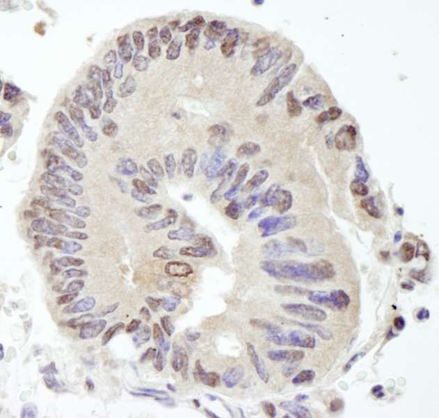 Detection of Human USP10 by Immunohistochemistry. Sample: FFPE section of human lung adenocarcinoma. Antibody: Affinity purified rabbit anti-USP10 used at a dilution of 1:100.