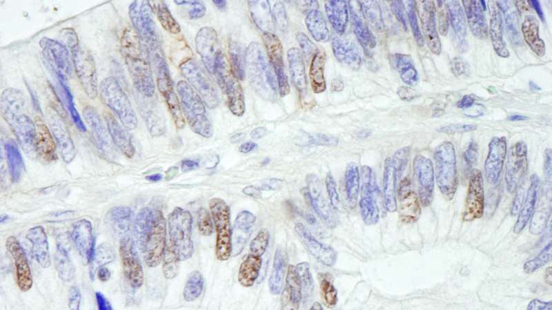 Detection of Human USP10 by Immunohistochemistry. Sample: FFPE section of human colon carcinoma. Antibody: Affinity purified rabbit anti-USP10 used at a dilution of 1:1000 (0.2 ug/ml). Detection: DAB.