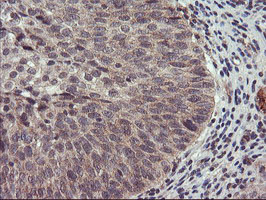 IHC of paraffin-embedded Carcinoma of Human bladder tissue using anti-USP10 mouse monoclonal antibody.
