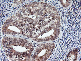 IHC of paraffin-embedded Adenocarcinoma of Human endometrium tissue using anti-USP10 mouse monoclonal antibody.