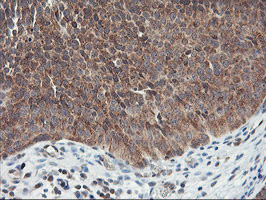IHC of paraffin-embedded Carcinoma of Human bladder tissue using anti-USP10 mouse monoclonal antibody.
