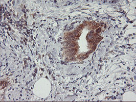 IHC of paraffin-embedded Carcinoma of Human pancreas tissue using anti-USP10 mouse monoclonal antibody.