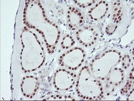IHC of paraffin-embedded Carcinoma of Human thyroid tissue using anti-USP10 mouse monoclonal antibody.