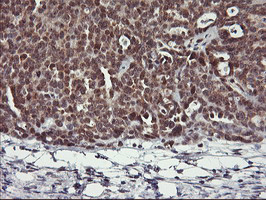 IHC of paraffin-embedded Adenocarcinoma of Human ovary tissue using anti-USP10 mouse monoclonal antibody.