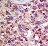 Formalin-fixed and paraffin-embedded human cancer tissue reacted with the primary antibody, which was peroxidase-conjugated to the secondary antibody, followed by AEC staining. This data demonstrates the use of this antibody for immunohistochemistry; clinical relevance has not been evaluated. BC = breast carcinoma; HC = hepatocarcinoma.