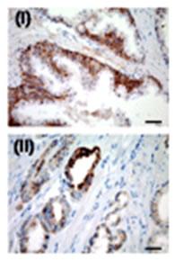 IHC for USP2a in a formalin-fixed, paraffin-embedded human prostate sample. Cytoplasmic positive immunostaining was detected in tumor glands (ii), whereas in normal prostatic epithelium, USP2a expression was restricted to the basal layer.