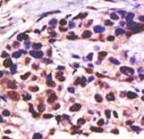 Formalin-fixed and paraffin-embedded human cancer tissue reacted with the primary antibody, which was peroxidase-conjugated to the secondary antibody, followed by DAB staining. This data demonstrates the use of this antibody for immunohistochemistry; clinical relevance has not been evaluated. BC = breast carcinoma; HC = hepatocarcinoma.