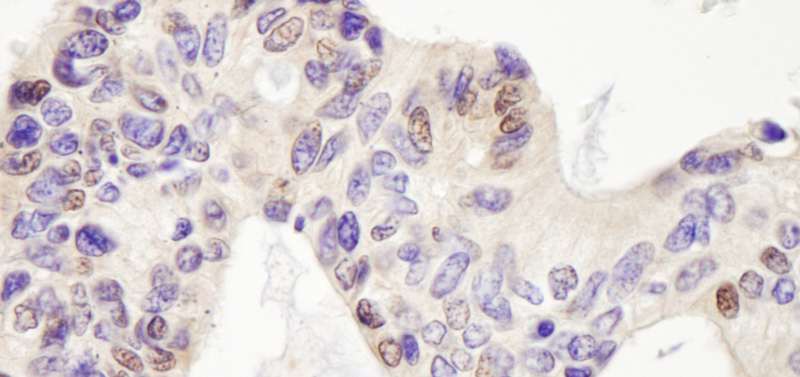 Detection of Human USP28 by Immunohistochemistry. Sample: FFPE section of human ovarian carcinoma. Antibody: Affinity purified rabbit anti-USP28 used at a dilution of 1:1000 (0.2 ug/ml). Detection: DAB.