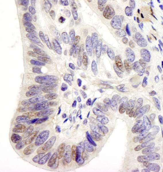 Detection of Human USP28 by Immunohistochemistry. Sample: FFPE section of human stomach adenocarcinoma. Antibody: Affinity purified rabbit anti-USP28 used at a dilution of 1:250.