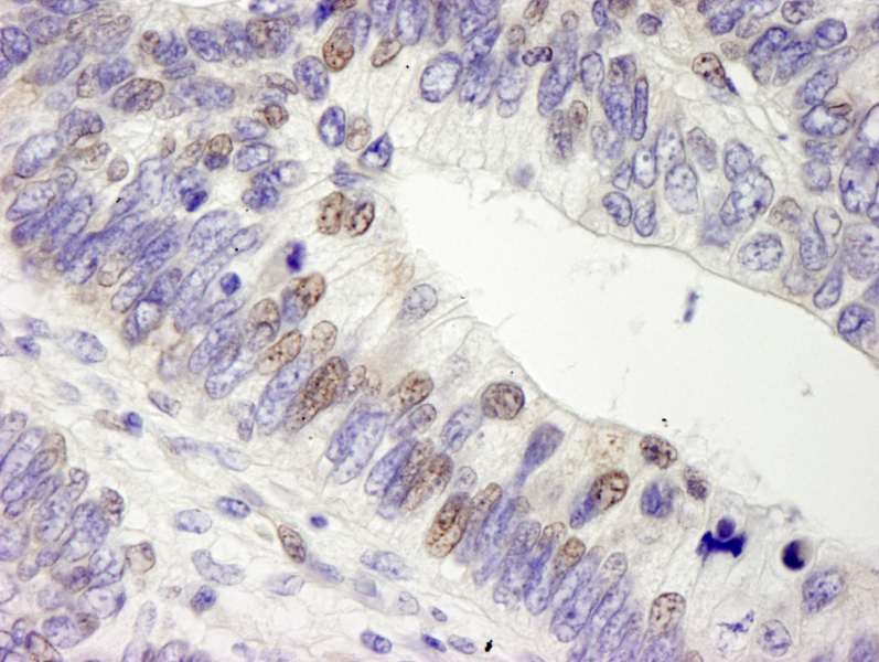 Detection of Human USP28 by Immunohistochemistry. Sample: FFPE section of human colon adenocarcinoma. Antibody: Affinity purified rabbit anti-USP28 used at a dilution of 1:250.