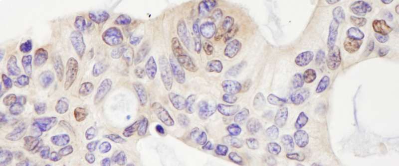 Detection of Human USP28 by Immunohistochemistry. Sample: FFPE section of human ovarian carcinoma. Antibody: Affinity purified rabbit anti-USP28 used at a dilution of 1:5000 (0.2 ug/ml). Detection: DAB.