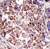 Formalin-fixed and paraffin-embedded human cancer tissue reacted with the primary antibody, which was peroxidase-conjugated to the secondary antibody, followed by DAB staining. This data demonstrates the use of this antibody for immunohistochemistry; clinical relevance has not been evaluated. BC = breast carcinoma; HC = hepatocarcinoma.
