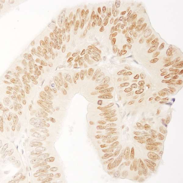 Detection of Human USP36/DUB1 by Immunohistochemistry. Sample: FFPE section of human colon carcinoma. Antibody: Affinity purified rabbit anti-USP36/DUB1 used at a dilution of 1:1000 (1 ug/ml). Detection: DAB.