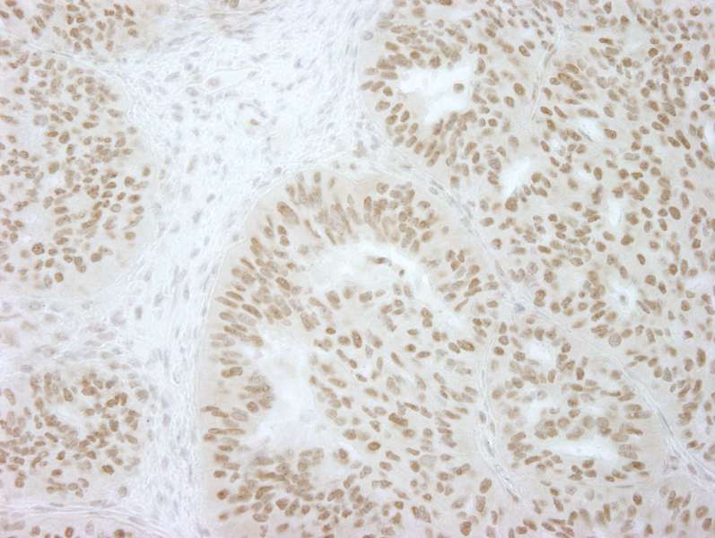 Detection of Human USP36/DUB1 by Immunohistochemistry. Sample: FFPE section of human breast carcinoma. Antibody: Affinity purified rabbit anti-USP36/DUB1 used at a dilution of 1:250. Epitope Retrieval Buffer-High pH (IHC-101J) was substituted for Epitope Retrieval Buffer-Reduced pH.