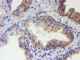 IHC of paraffin-embedded Carcinoma of Human prostate tissue using anti-USP36 mouse monoclonal antibody.